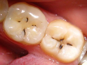 Лечение зубного кариеса