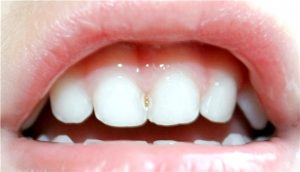 Кариес молочных зубов и особенности