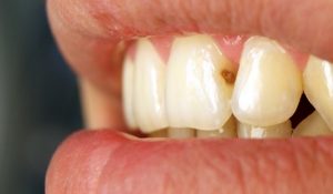 Передние зубы и кариес