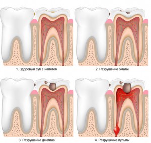 Лечение и профилактика кисты на зубах