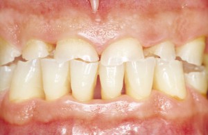 Классификация повышенной стираемости зубов