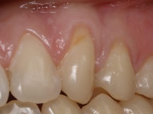 Клиновидный дефект в стоматологии