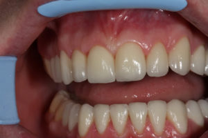 Какие коронки на зубы лучше поставить?