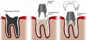 Коронки в стоматологии