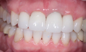Фарфоровые коронки на зубы