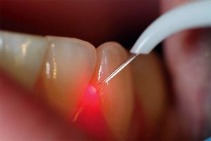 Какие преимущества имплантации зубов с помощью лазера?