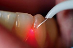 Методика лазерной имплантации зубов