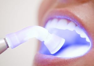 Основные преимущества лазерной стоматологии