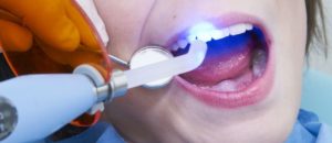 Лечение зубов лазером: новое слово в стоматологии