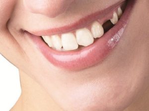 Какие последствия отсутствия зубов?