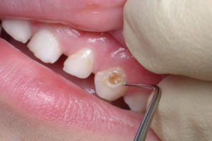Как защитить детские зубы от кариеса?