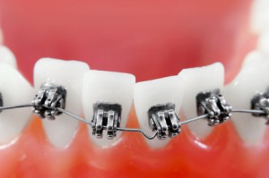Лечение в ортодонтии