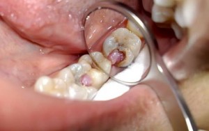Каналы зуба и их лечение