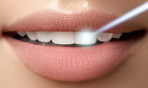 Лазерная терапия и хирургия зубов