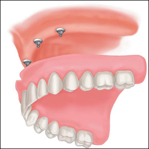 Протезирование зубов мини-имплантами