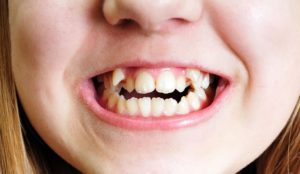 Почему у ребенка растут зубы не ровно?