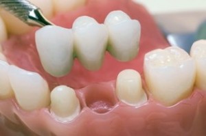 Несъемные протезные конструкции на зубы