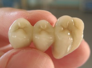 Мостовидный протез в стоматологии