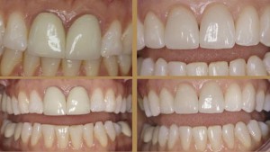Удаление зубного налёта и камней, стоматологическая клиника в Сумах