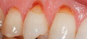 Оголение шеек зубов