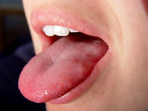 Опух язык