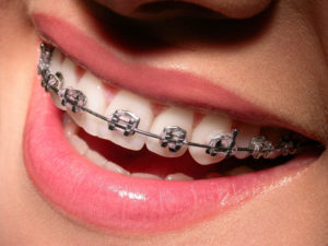 Ортодонтическая стоматология. Как происходит лечение?