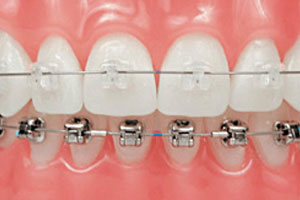 Что такое ортодонтия? Немного о терминах и понятиях