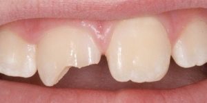 Травмы зубов в стоматологии
