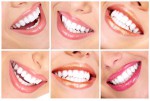 Эффективное отбеливание зубов 