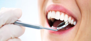 Частые вопросы пациентов по отбеливанию зубов