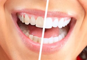 Какое отбеливание зубов лучше?