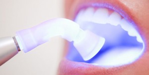 Профессиональное стоматологическое отбеливание зубов