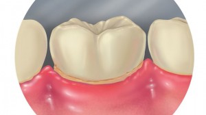 Профилактика заболеваний зубов - парадонтит