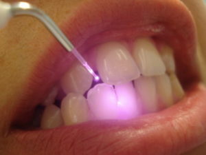 Лазер в стоматологии. Что такое и зачем применять?