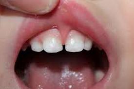 Пластика уздечек губ и языка
