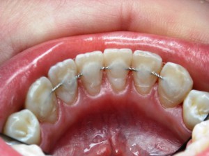 Как бороться с подвижностью зубов?