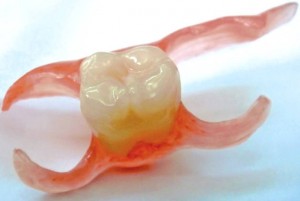 Зубной протез "бабочка"