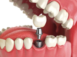 Что такое протезирование зубов?