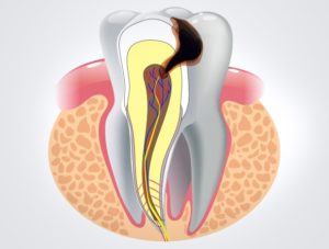 Воспаление пульпы в стоматологии