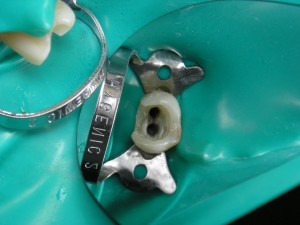 Мифы и реальности про отбеливания зубов
