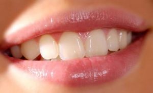 Реставрация зубов посредством фотополимерных материалов