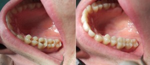 Проблемы при реставрации зубов и их решение