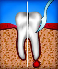 Резекция верхушки корня как зубосохраняющая операция