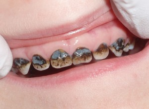 Советы и описания по серебрению зубов