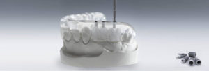 Имплантация зубов по шаблону