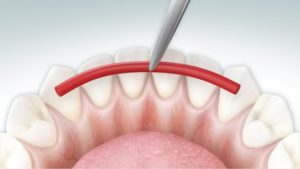 Шинирование зубов в современной стоматологии