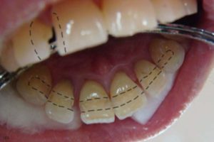 Современное шинирование зубов