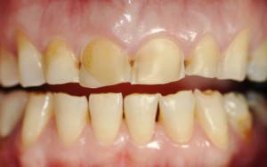 Восстановление зубов при стираемости