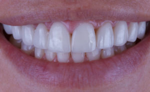 Показания к установке виниров на передние зубы