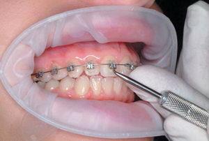 Установка брекетов на зубы